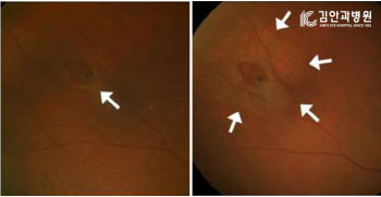 실명 일으키는 망막박리, 10년 동안 2배 가량 급증
