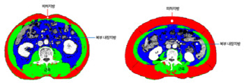 "살찔수록 대장암 재발 위험 더 적다"