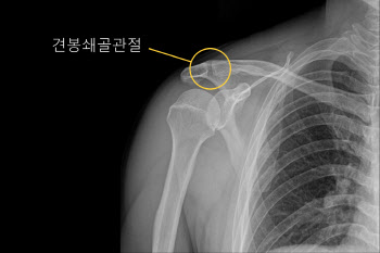 국제성모 김영욱 교수, 관절 단면적 이용 견봉쇄골 관절염 진단법 개발