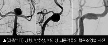 4060 여성 사망에 이르게 하는 ‘뇌동맥류’... 파열되기 전 검진으로 예방