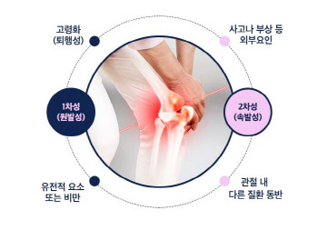 "퇴행성관절염 예방 위해선, 나이가 들수록 다이어트해야"