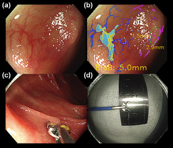 대장암 씨앗 ‘대장 용종’, AI 이용 정확한 크기 측정법 개발