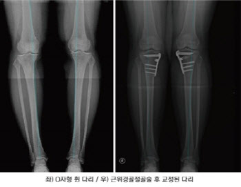 중년의 O다리 변형, 무릎 건강 적신호