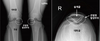 무릎 굽힐 때면 '시큰' 앞무릎 통증, 슬개대퇴관절염