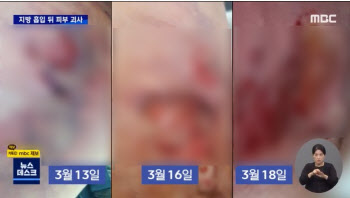 “닿기만해도 쓰라려” 지방흡입 후 허벅지 괴사… 병원은 환자 탓