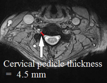 중심경추협착증 새 진단법 개발