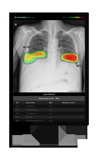 루닛 "인사이트 CXR, 경력 20년 전문의 수준 정확도 입증"