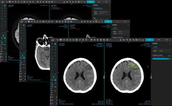 제이엘케이, 북미영상의학회서 뇌졸중 AI 솔루션 선봬
