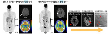 서울대병원, 뇌졸중 예후 예측하는 새로운 지표 확인