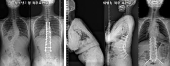 목뒤 통증, 어깨·팔 저림 느껴진다면 척추 점검해 보세요