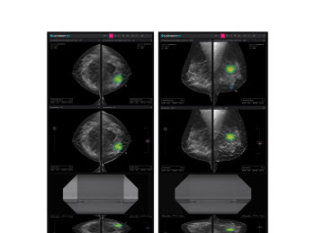 루닛, 3차원 유방암 검진 AI솔루션 이달 말 유럽 판매 개시