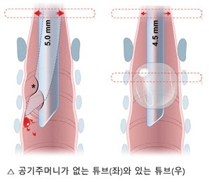 소아응급환자 기관 내 삽관시 ‘공기주머니’ 있는 튜브 권고