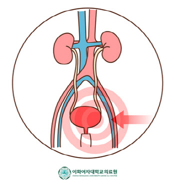 "아랫배 묵직, 뻐근한 증상 있다면 간질성 방광염 의심해봐야"