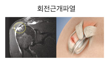 나이 만큼 중요한 생활 습관, 내 어깨 통증 구별법