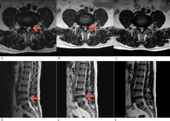 "척추에 생긴 '물혹', 허리디스크로 오인하기 쉬워"