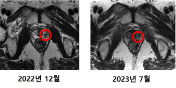 국내 첫 중입자치료 환자, 암 조직 제거 확인