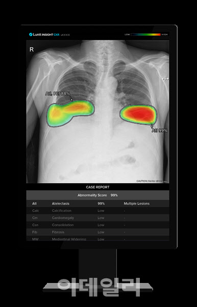 루닛, 삼성전자에 흉부 엑스레이 판독 AI 솔루션 공급