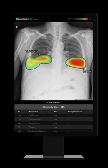 루닛, 삼성전자에 흉부 엑스레이 판독 AI 솔루션 공급