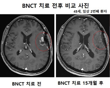 가천대 길병원, A-BNCT 개발로 '악성종양 교모세포종' 극복에 나서