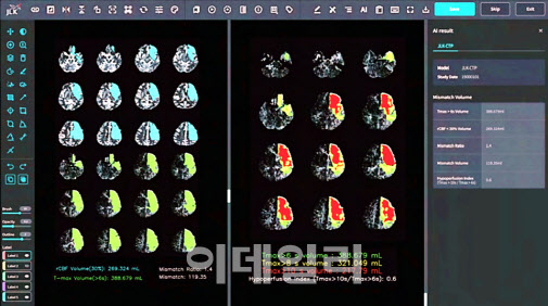 [단독]제이엘케이, 두번째 AI 뇌 질환 진단 솔루션 FDA 승인...美 레피드AI 제쳤다