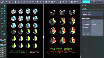 제이엘케이, 두번째 AI 뇌 질환 진단 솔루션 FDA 승인...美 레피드AI 제쳤다