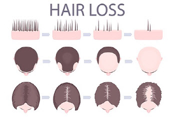 ①‘호르몬·JAK약’이 장악한 탈모시장 뒤엎을 K바이오는