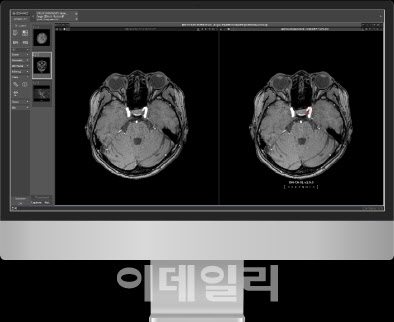 딥노이드, 업계 최초 뇌동맥류 AI 진단 솔루션 보험 등재