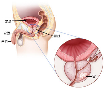 전립선암, 초기엔 대부분 증상 없어···증상 동반되면 늦어