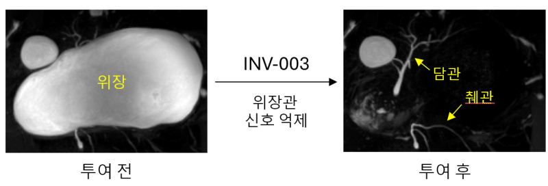 INV-003 투여 전후 MRCP 영상 비교 (사진=인벤테라)