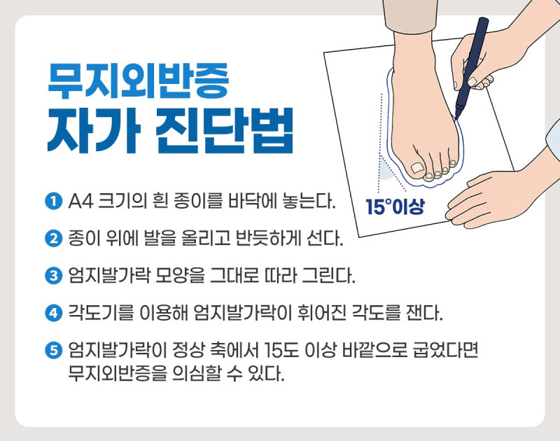 무지외반증, 발 모양 변화 넘어 보행과 무릎 통증까지 영향