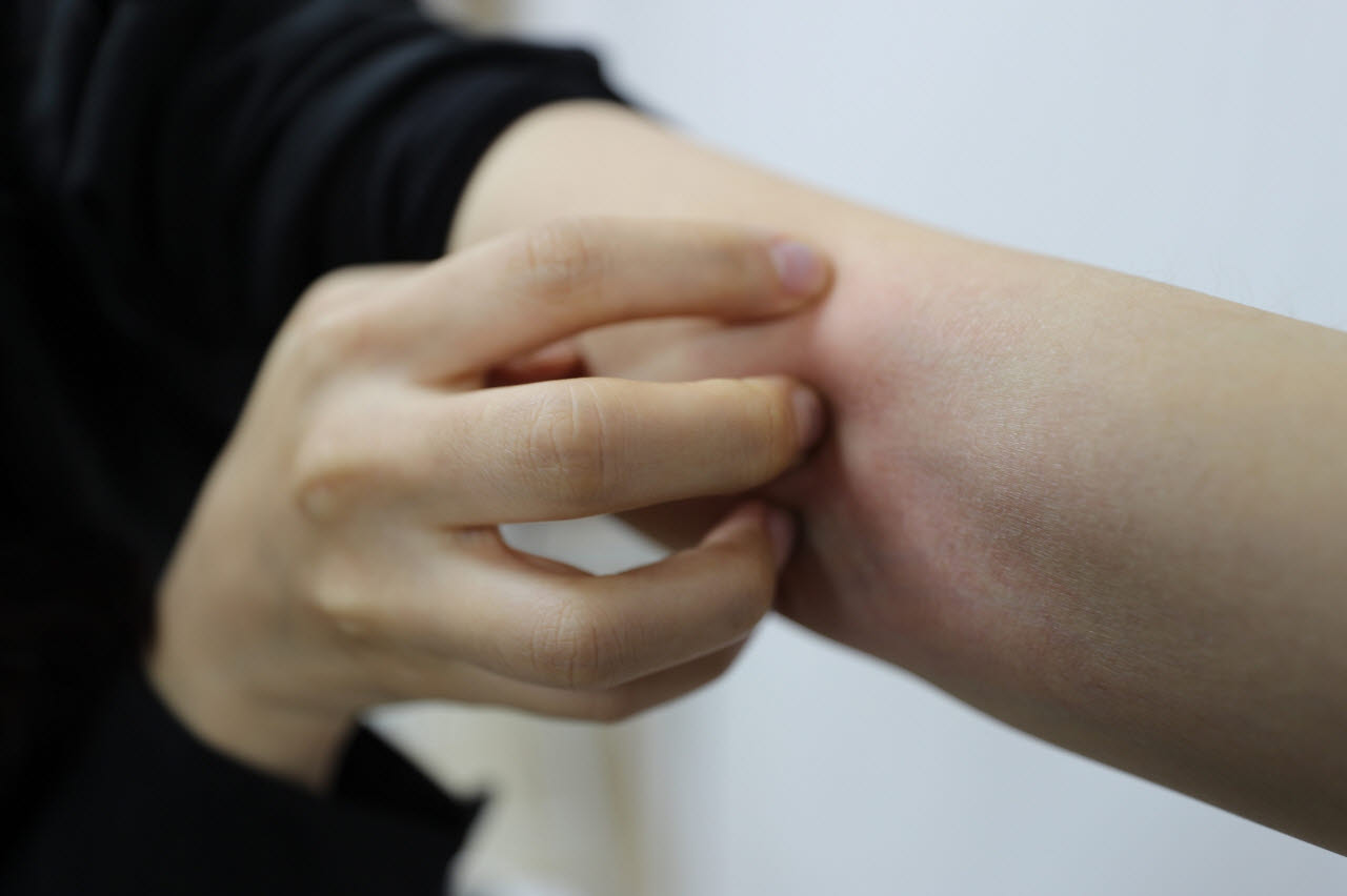 땀과 자외선, 냉방기까지…여름철 습진 주의보 발령