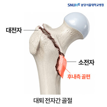 불안정성 대퇴 전자간 골절. 대전자와 소전자의 사이가 부러질 때 후내측 골편도 같이 떨어지면 예후가 더 좋지 않다고 해, 불안정한 대퇴 골절 중 하나로 평가한다.