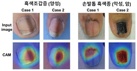 흑색조갑증(양성)에 비해 손발톱 흑색종(악성, 암)은 빠르게 넓어지거나 진해지는 경우가 많으며, 손톱 주변의 피부까지 퍼지는 양상을 보인다. 흑색종은 불규칙하고 다양한 색상을 나타내며, 손발톱이 갈라지거나 부서지는 경향이 동반되기도 한다. AI가 두가지를 구분하는데에 중요한 부분을 활성화(Class Activation Map, CAM)해 보여주고 있다.