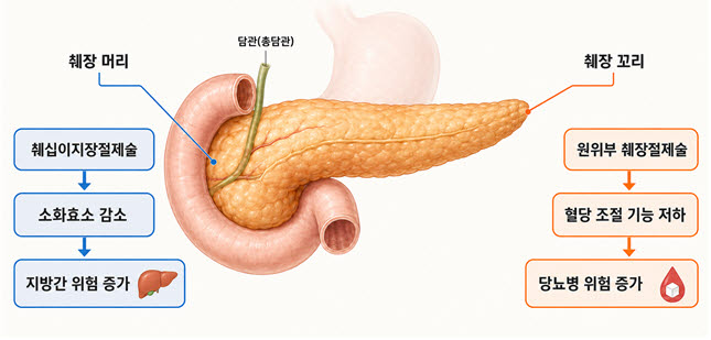 췌장 절제 부위에 따른 대사기능 변화 개념도.