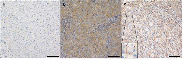 LAMTOR2 발현의 대표적인 면역조직화학(IHC) 이미지: a.정상 간 조직 b.VETC 음성 종양세포 c.VETC 양성 종양세포(가장자리가 진하게 염색되는 ‘주변부 강조’ 패턴 관찰됨).