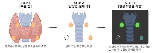형광조영술 기반 로봇 갑상선 후 부갑상선 기능 예측법 개념도.  수술 전 부갑상선 기능과 수술 중 로봇 형광조영술로 확인한 부갑상선 혈류를 연구팀이 만든 계산식에 대입하면, 환자 10명 중 7명에서 수술 후 부갑상선 기능을 오차 범위 내로 미리 예측할 수 있다.