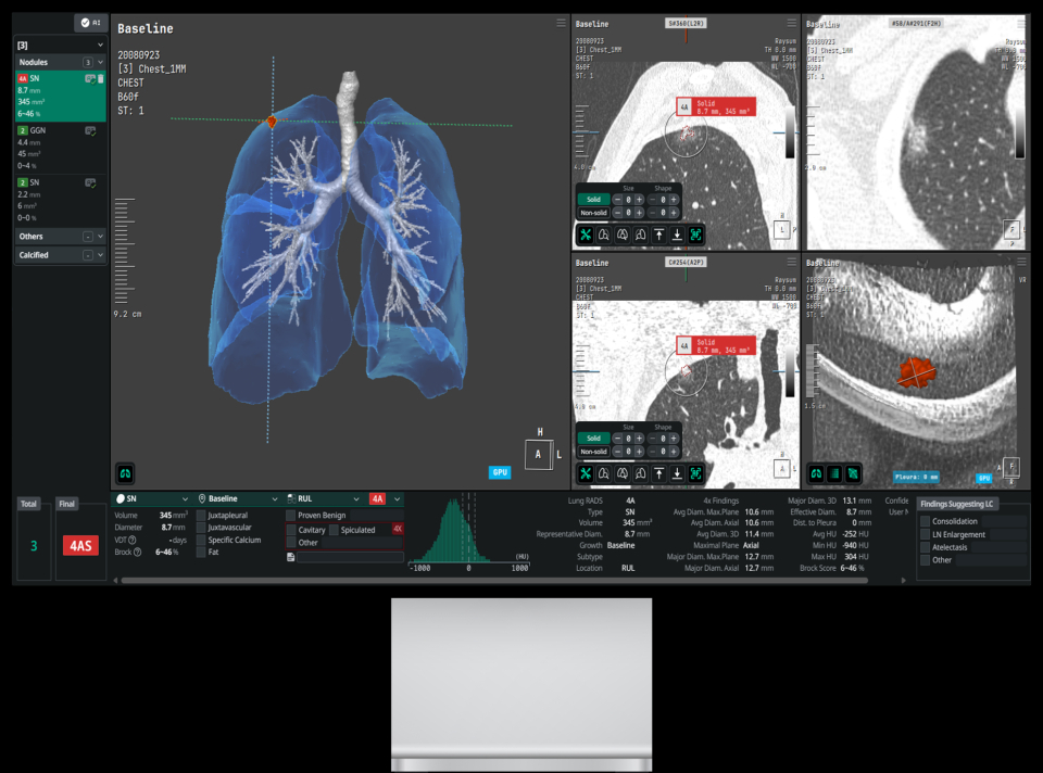 코어라인소프트에 따르면 폐결절 검출 AI ‘에이뷰 렁 노듈 CAD’(AVIEW Lung Nodule CAD) (자료=코어라인소프트)