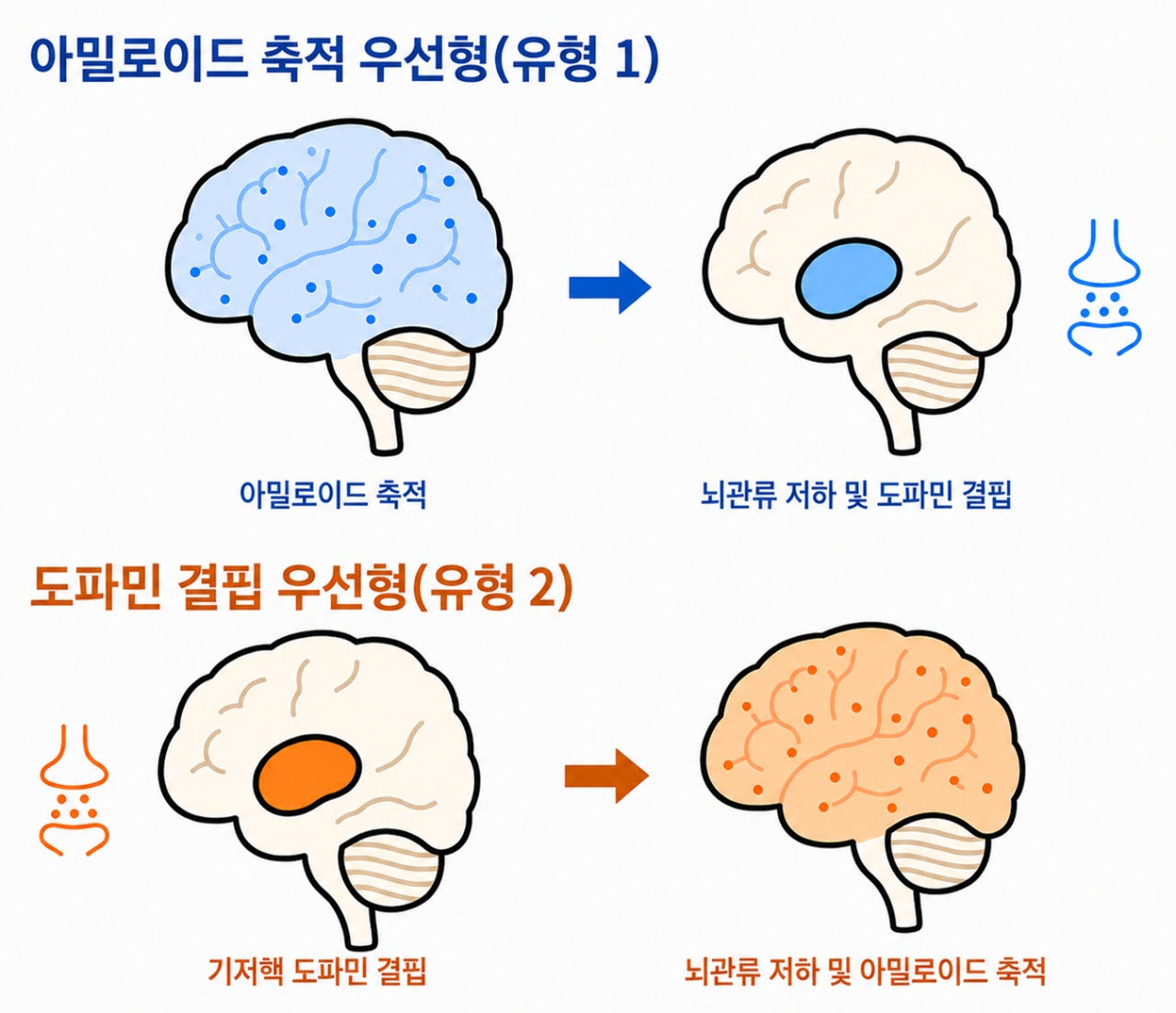 루이소체치매 진행유형 구분.