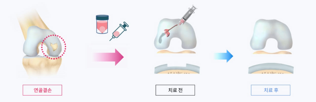에이템즈 골관절염 치료제 파이프라인 ‘A-Paste-C’. (사진=에이템즈)