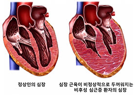 비후성 심근증 모식도.
