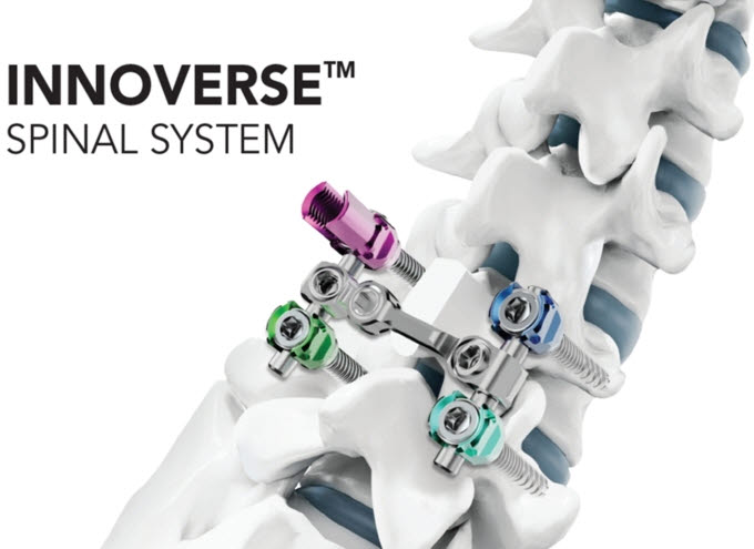 시지메드텍의 척추 고정 장치 ‘이노버스 스파이널 시스템’(INNOVERSE Spinal System) (자료=시지메드텍)