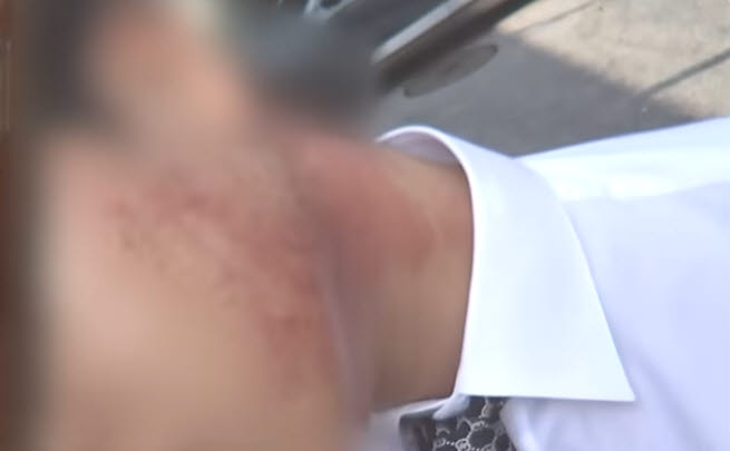 지난 12일 서울 용산구 한남동의 한 외제차 매장에서 50대 남성 A씨에게 폭행당한 직원의 얼굴과 목 부위에 붉은 상처가 남아 있다. (사진=YTN 보도 캡처)