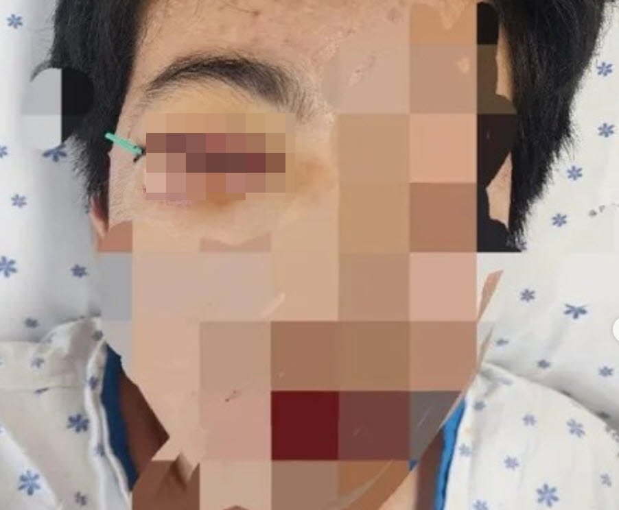 학교 폭력으로 안와 골절 피해를 입은 학생. 가해 학생과 같은 반으로 분리가 이뤄지지 않아 추가 피해가 두려워 한 달이 넘도록 등교를 하지 못하고 있다. 학교 교장은 