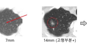 "안 자란다" 했던 순수 간유리 폐결절, 10년 이후 크기 변화나타나