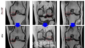 바이오솔루션, 미국 2상 중간결과 발표 "연골 재생 확연히 나타나"