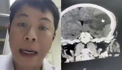 “뻐근해” 아내한테 목 마사지 받았다가...‘뇌 괴사'한 남성