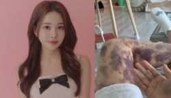 '건강주사'에 전신 피멍 아옳이…병원 상대 ‘13억 소송' 승소