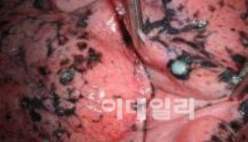 30년 이상 흡연 시 소세포폐암 위험 '54배'