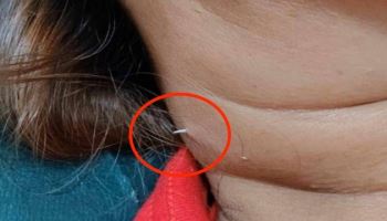2주 전 삼킨 ‘생선 가시’, 목 뚫고 나와…“이것 하지 마세요”
