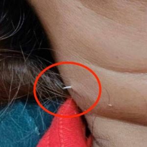 2주 전 삼킨 ‘생선 가시’, 목 뚫고 나와…“이것 하지 마세요”